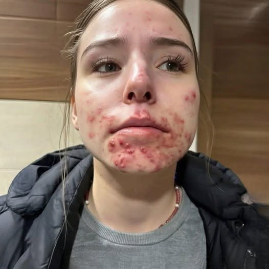 When an Itch Becomes a Warning — A Life Changed by Diagnosis