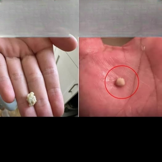 Tonsil Stones: Causes, Symptoms, Treatment, and Prevention Tips