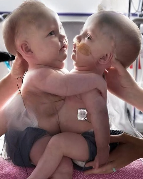 The twin sisters were born joined at the chest and abdomen: you will be shocked when you see them after the separation