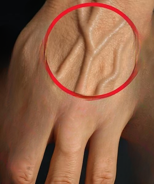 What the Veins on Your Hands Might Reveal About Your Kidney Health
