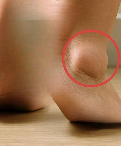 Understanding Swollen Feet in Seniors: Causes, Prevention, and Relief Strategies