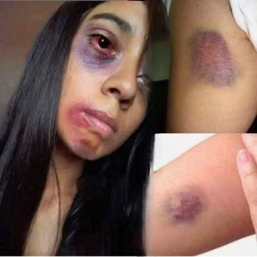 Dangerous Online Challenges: Teen Hospitalized After Experimenting with Foreign Objects