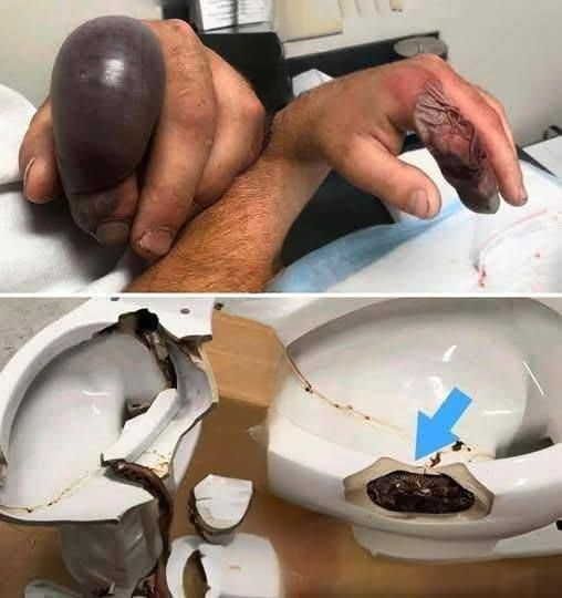 When Danger Hides Below: The Rare and Shocking Toilet Snake Attack