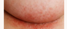 How to Soothe an Itchy Rash Under the Breasts During Winter