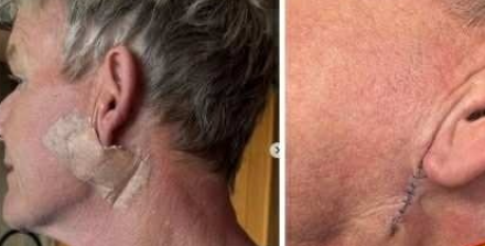 Fans in Shock as Gordon Ramsay Reveals Cancer Battle — Chef Shows Surgery Scars After Diagnosis