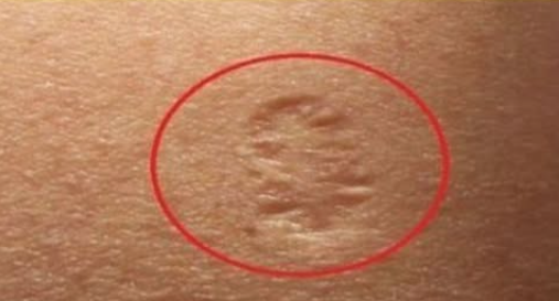 The Meaning Behind the Smallpox Vaccine Scar: A Deep Historical and Medical Exploration