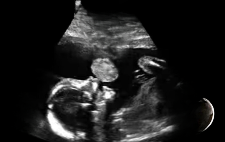 From Fear to Hope: The Ultrasound That Changed Everything