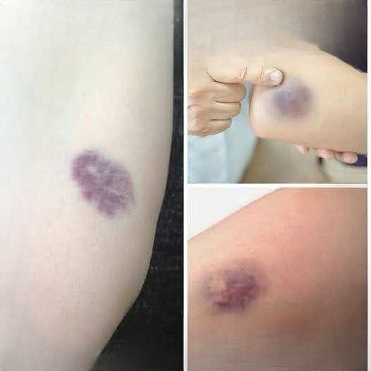 Unexplained Bruises? What Your Body Might Be Trying to Tell You