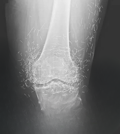Doctors Surprised After X-Ray Reveals Unusual Findings in Woman’s Knee