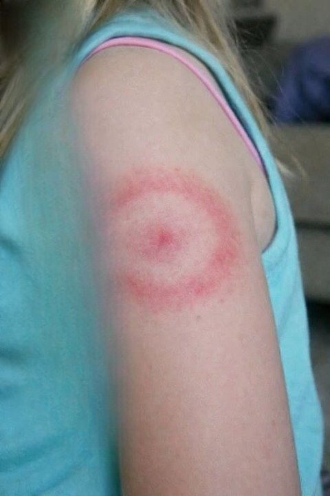 A Red Ring on Your Child’s Skin: What It Might Mean and When to Seek Advice