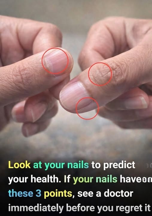 Vertical Nail Ridges: Why They Happen More as You Get Older