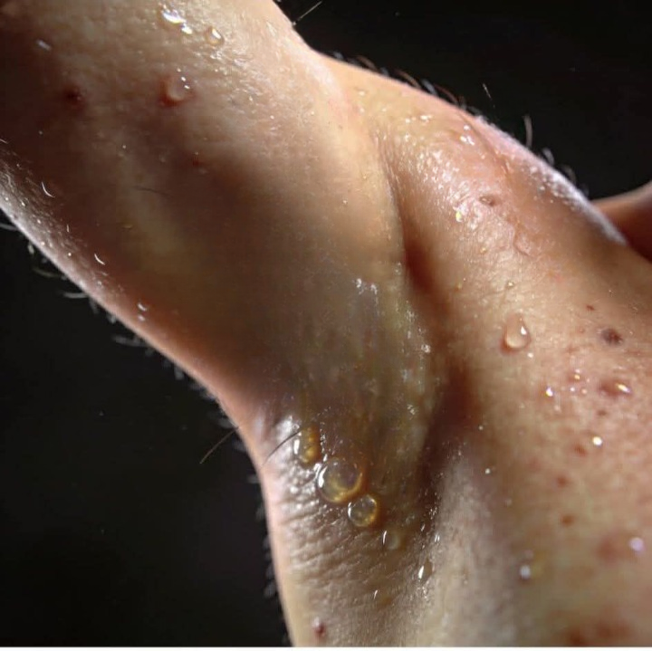 Small Lumps Under the Arm: What They Might Mean and When to Worry