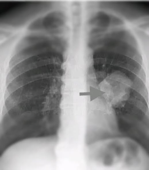 Global Health Alert: Scientists Report a Mysterious New Cancer Type