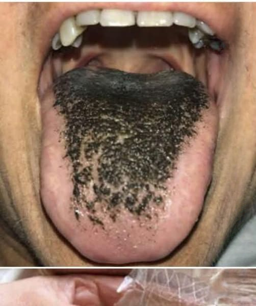 Black Hairy Tongue: Understanding the Strange Condition and How to Fix It