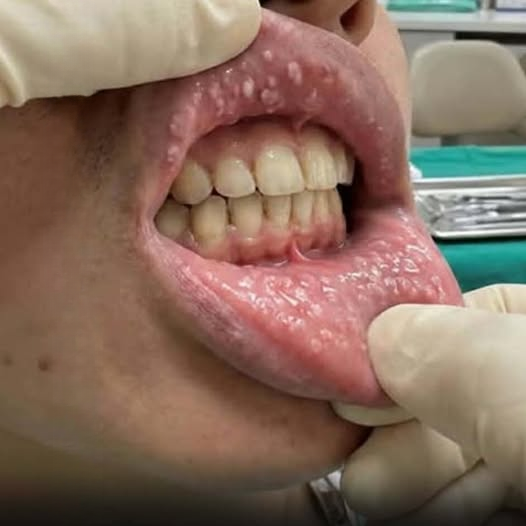 Lumps on the Lips: Understanding When They Are Harmless and When to Seek Medical Attention