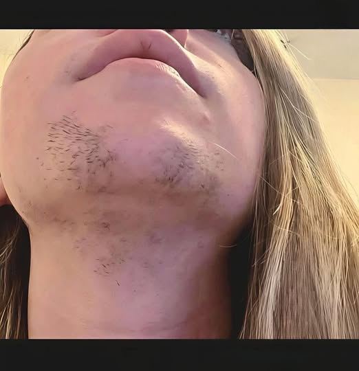Understanding Facial Hair Growth in Women: Causes, Treatments, and Lifestyle Tips