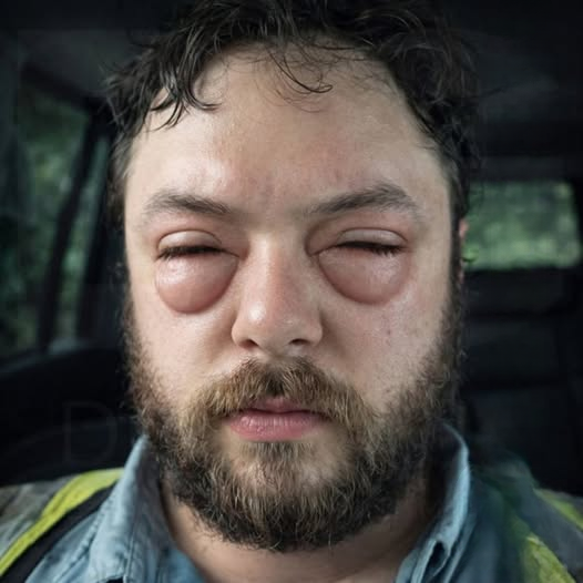Bumps on the Eye: Causes, Symptoms, and When to Seek Care