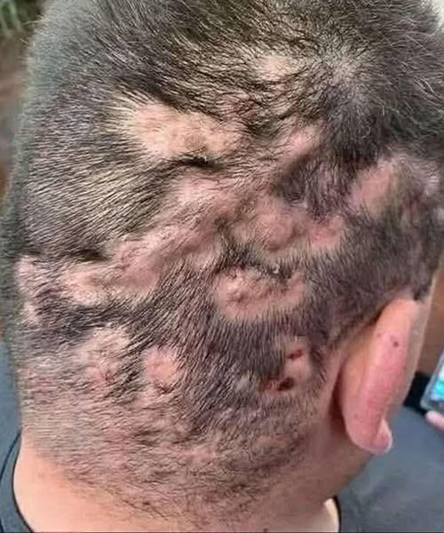The First Signs Your Body May Be Struggling: Understanding Acanthosis Nigricans