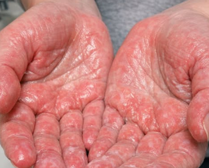 My Hands Burn When I Apply Lotion: What You Can Do When Medical Advice Isn’t Immediately Available