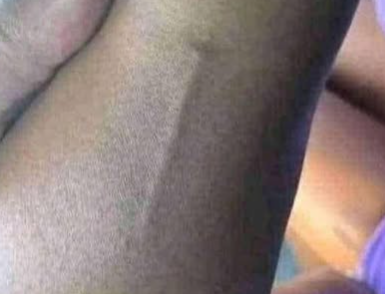 Found This on My Daughter’s Arm — What Could It Be?