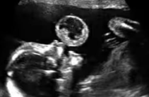 What Looked Like a “Bubble” on an Ultrasound Turned Into a Life-Changing Discovery