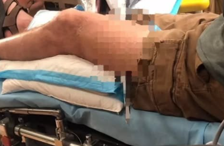 Young Woman Hospitalized After Sawfish Encounter: A Wake-Up Call About Marine Safety and Awareness