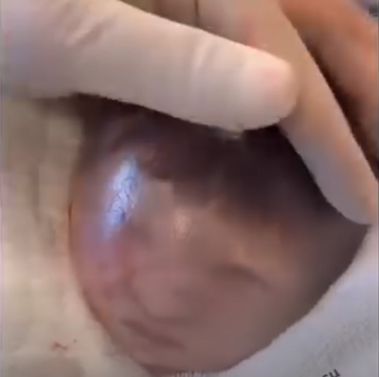 Baby Born Clutching Mother’s IUD: A Rare and Astonishing Birth Story