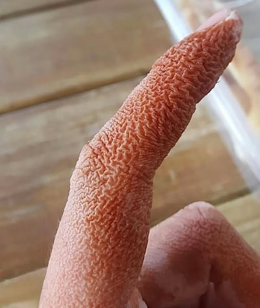 ALERT: Rare Skin Reaction Linked to Medication Change — What to Watch For