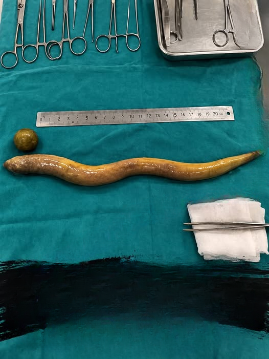 He Went to the Hospital With Pain… Doctors Found Something Unbelievable