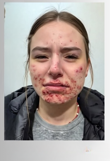 The Hidden Reasons You Keep Getting Pimples on Your Chin