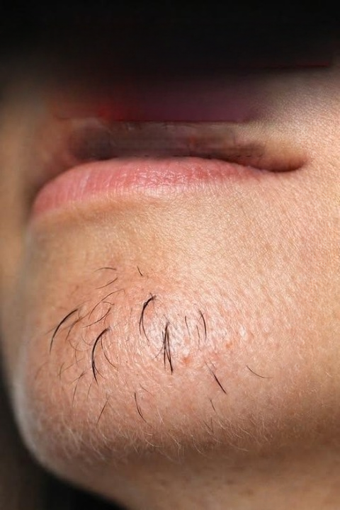 Chin Hair in Women: Why It Happens and How to Manage It Confidently
