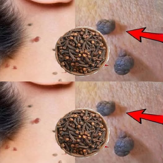 Can Cloves Help With Skin Tags and Warts? What to Know Before Trying Home Remedies