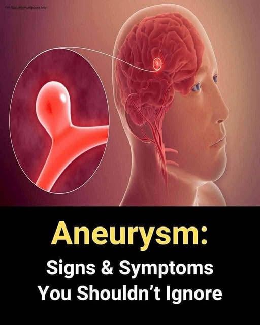 12 Warning Signs of a Brain Aneurysm You Should Never Ignore