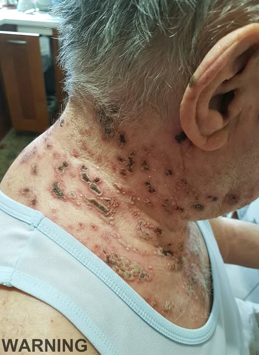The Silent Disease That Can Strike Without Warning: Understanding Shingles