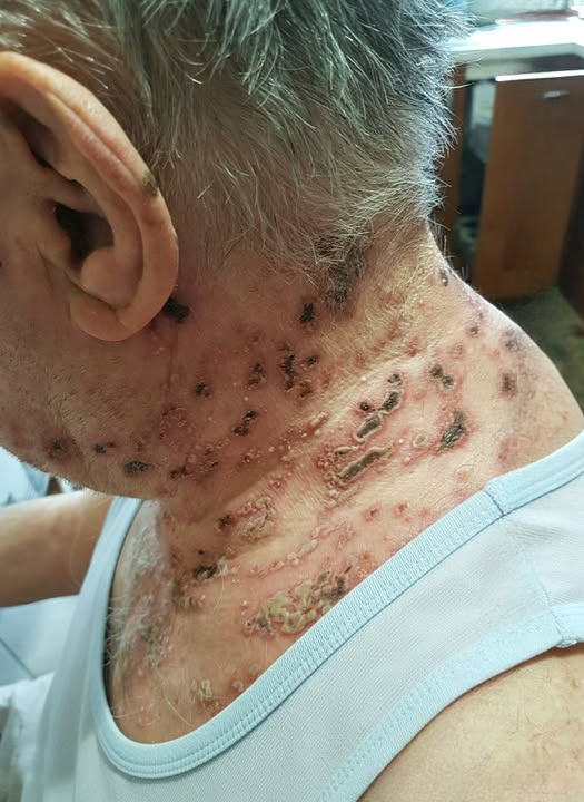 The Silent Virus Within: Understanding Shingles and How to Take Control of Your Health