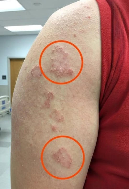 Noticing Red Circular Marks on Your Arm? Here’s What They Could Mean