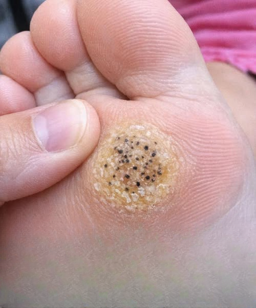 A Painful Spot on My Daughter’s Foot Appeared Right Before Her Dance Recital — Here’s What Parents Should Know