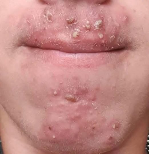 Why Pimples or Irritation Can Suddenly Appear Around the Mouth