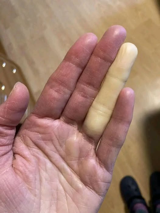 Why Fingers Suddenly Turn White: Understanding Raynaud’s phenomenon and Its Symptoms