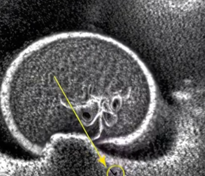 Child’s Stomach Pain Turned Out to Be a Medical Emergency Doctors Warn Parents About