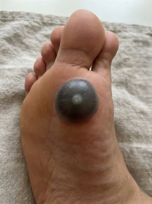 Painful Foot Blister in Children: Common Causes, Symptoms, and Safe Treatment Tips