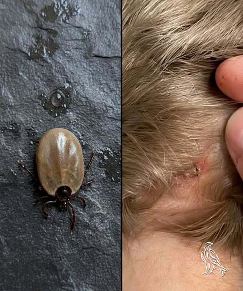How to Stay Calm When You Find Unwanted “Guests” in Your Child’s Hair