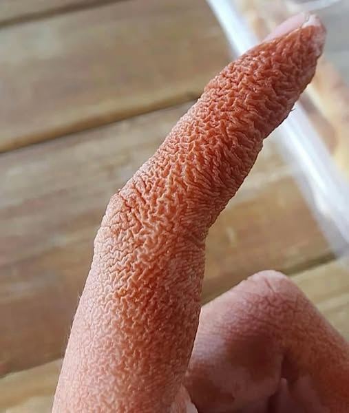 Sweet Syndrome: Understanding the Rare Skin Condition, Symptoms, Diagnosis, and Treatment
