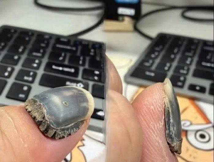 What Can Happen When Nail Damage Goes Ignored? Experts Warn About the Hidden Risks Behind Artificial Nail Overuse