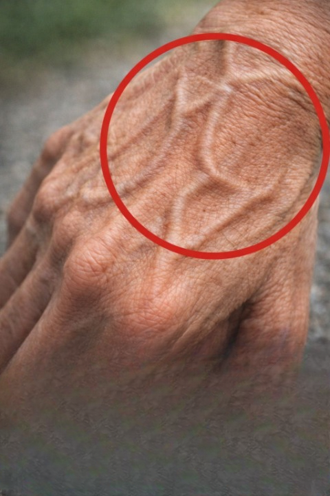 Understanding Sudden Bulging Veins: Causes, Symptoms, and When to Seek Help