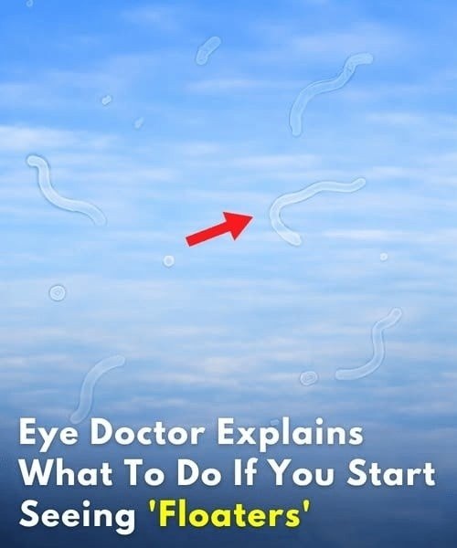 Eye Floaters: When They’re Usually Harmless—and When You Should Get Them Checked