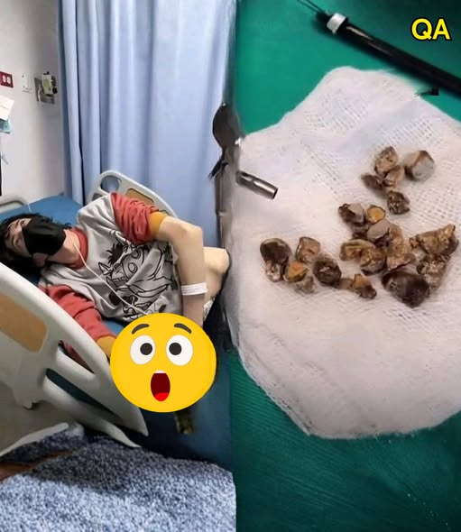 Doctors Shocked After Patient Develops Severe Kidney Stone Complications