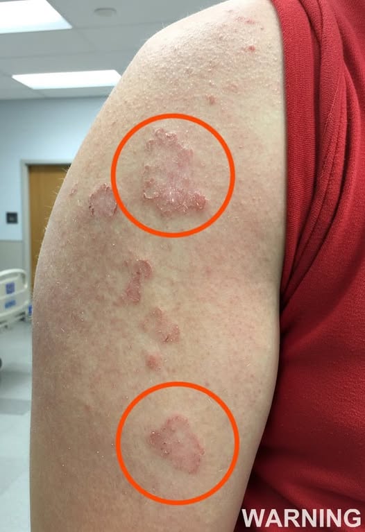 Red Circular Marks on Your Arm: What Could They Mean?