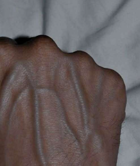 What Does It Mean When Your Veins Become More Visible?